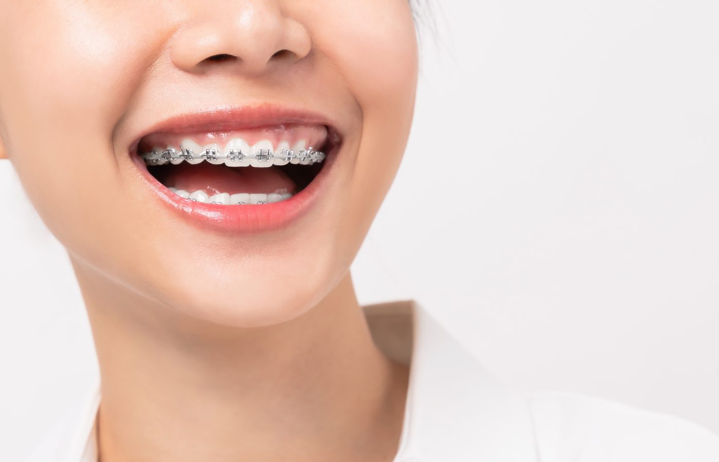 Sourire avec traitement orthodontique